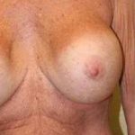 A Before Photo of a Breast Revision Plastic Surgery by Dr. Alberico Sessa in Sarasota