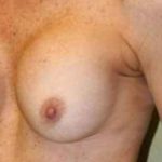 A Before Photo of a Breast Revision Plastic Surgery by Dr. Alberico Sessa in Sarasota