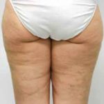 A Before Photo of Cellulite Reduction by Dr. Alberico Sessa in Sarasota