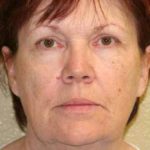 A Before Photo of a Chemical Peel In Sarasota