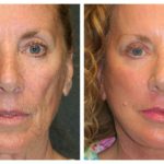 A Before & After of a Facelift Plastic Surgery by Dr. Alberico Sessa in Sarasota