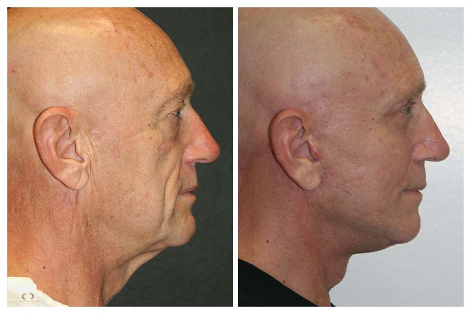 A Before & After of a Facelift Plastic Surgery by Dr. Alberico Sessa in Sarasota