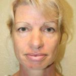 A Before Photo of a Facelift by Dr. Alberico Sessa in Sarasota