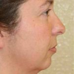A Before Photo of Facial Implant Plastic Surgery by Dr. Alberico Sessa