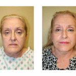A Before & After of a Fat Grafting Plastic Surgery by Dr. Alberico Sessa in Sarasota