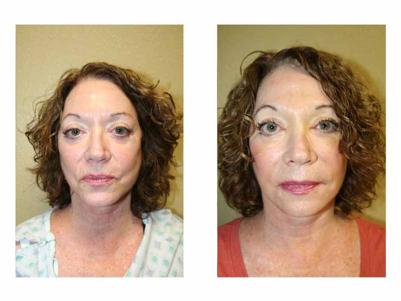 A Before & After of a Fat Grafting Plastic Surgery by Dr. Alberico Sessa in Sarasota
