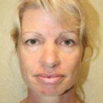 A Before Photo of Filler Injections In Sarasota