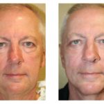 A Before & After of a Fractional Laser Resurfacing Plastic Surgery by Dr. Alberico Sessa in Sarasota