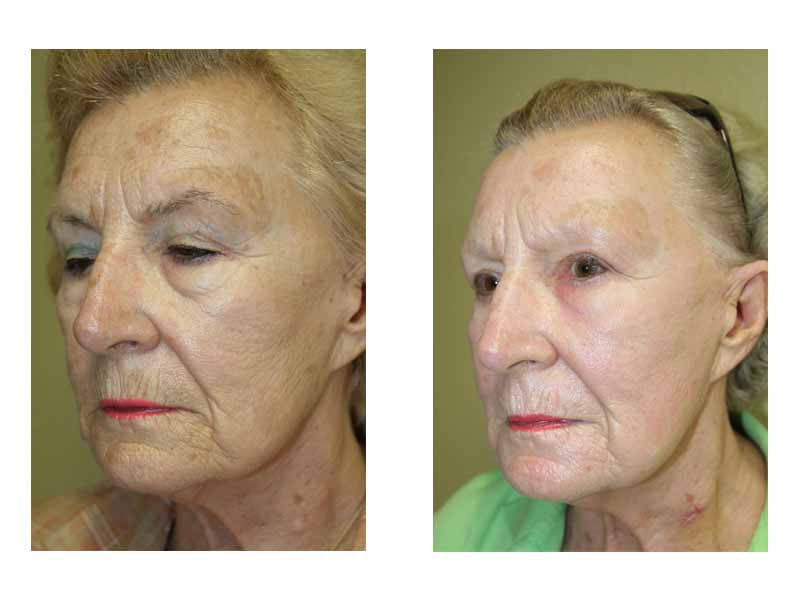 A Before & After of a Fractional Laser Resurfacing Plastic Surgery by Dr. Alberico Sessa in Sarasota