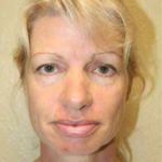 A Before Photo of CO2 Laser Plastic Surgery by Dr. Alberico Sessa in Sarasota