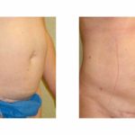 A Before & After of a Laser Liposuction Plastic Surgery by Dr. Alberico Sessa in Sarasota