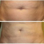 A Before & After of a Laser Liposuction Plastic Surgery by Dr. Alberico Sessa in Sarasota