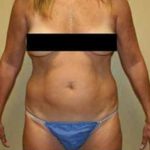 A Before Photo of Laser Liposuction Plastic Surgery by Dr. Alberico Sessa in Sarasota