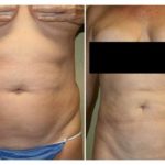 A Before & After of a Liposuction Plastic Surgery by Dr. Alberico Sessa in Sarasota