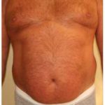 A Before Photo of Liposuction Plastic Surgery by Dr. Alberico Sessa in Sarasota