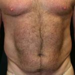 A Before Photo of Liposuction Plastic Surgery by Dr. Alberico Sessa in Sarasota