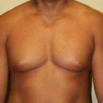 A Before Photo of Gynecomastia Plastic Surgery by Dr. Alberico Sessa in Sarasota