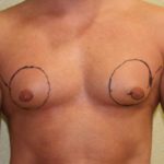 A Before Photo of Gynecomastia Plastic Surgery by Dr. Alberico Sessa in Sarasota
