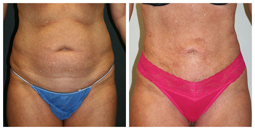 A Before & After of a Mini Tummy Tuck Plastic Surgery by Dr. Alberico Sessa in Sarasota