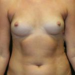 A Before Photo of a Mini Tummy Tuck Plastic Surgery by Dr. Alberico Sessa in Sarasota