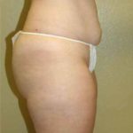 A Before Photo of a Mini Tummy Tuck Plastic Surgery by Dr. Alberico Sessa in Sarasota