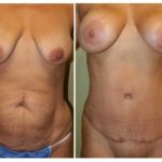 A Before & After of a Mommy Makeover Plastic Surgery by Dr. Alberico Sessa in Sarasota