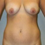 A Before Photo of a Mommy Makeover Plastic Surgery by Dr. Alberico Sessa in Sarasota