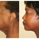 A Before & After of a Neck Lift Plastic Surgery by Dr. Alberico Sessa in Sarasota