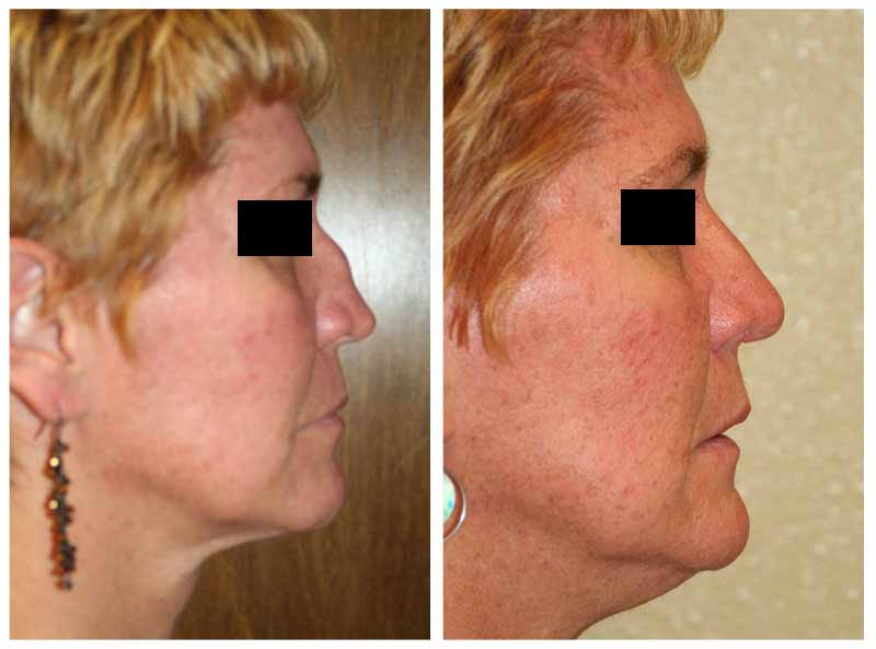 A Before & After of a Rhinoplasty Plastic Surgery by Dr. Alberico Sessa in Sarasota