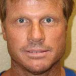 A Before Photo of a Rhinoplasty Plastic Surgery by Dr. Alberico Sessa In Sarasota