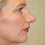 A Before Photo of a Rhinoplasty Plastic Surgery by Dr. Alberico Sessa In Sarasota