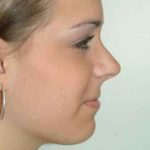 An After Photo of a Rhinoplasty Plastic Surgery by Dr. Alberico Sessa In Sarasota