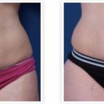 A Before & After Of Non-Surgical Skin Tightening by Dr. Alberico Sessa in Sarasota