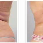 A Before & After Of Non-Surgical Skin Tightening by Dr. Alberico Sessa in Sarasota