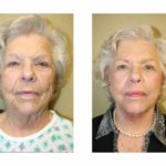 A Before & After of a SmartLift Facelift Plastic Surgery by Dr. Alberico Sessa in Sarasota