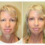 A Before & After of a SmartLift Facelift Plastic Surgery by Dr. Alberico Sessa in Sarasota