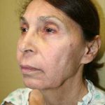 A Before Photo of a Smartlift Facelift Plastic Surgery by Dr. Alberico Sessa in Sarasota
