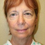 A Before Photo of a Smartlift Facelift Plastic Surgery by Dr. Alberico Sessa in Sarasota
