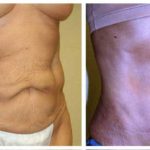 A Tummy Tuck Before & After Photo by Dr. Alberico Sessa in Sarasota