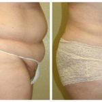 A Tummy Tuck Before & After Photo by Dr. Alberico Sessa in Sarasota