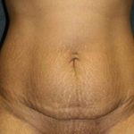 A Before Photo of a Tummy Tuck Plastic Surgery by Dr. Alberico Sessa