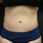 An After photo of a Tummy Tuck Plastic Surgery by Dr. Alberico Sessa in Sarasota