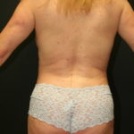 An After Photo of a Brazilian Butt Lift Plastic Surgery by Dr. Alberico Sessa in Sarasota