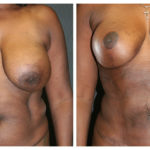 A Before and After Photo of a Breast Lift Plastic Surgery by Dr. Alberico Sessa in Sarasota