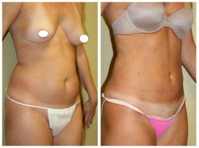 A Before and After Photo of Liposuction 360 Plastic Surgery by Dr. Alberico Sessa in Sarasota