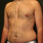 An After Photo of a Gynecomastia Cosmetic Surgery by Dr. Alberico Sessa in Sarasota