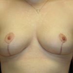 An After Photo of a Breast Lift Plastic Surgery by Dr. Alberico Sessa in Sarasota