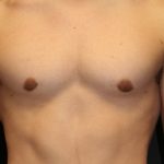 An After Photo of Gynecomastia Plastic Surgery by Dr. Alberico Sessa in Sarasota