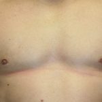 An After Photo of a Male Breast Reduction Surgery by Dr. Alberico Sessa in Sarasota