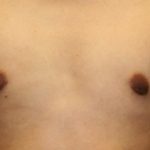 An After Photo of a Gynecomastia Plastic Surgery by Dr. Alberico Sessa in Sarasota